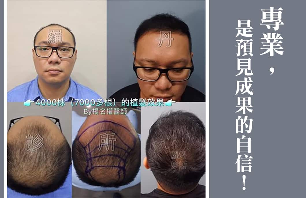 【植髮】專業，是預見成果的自信！